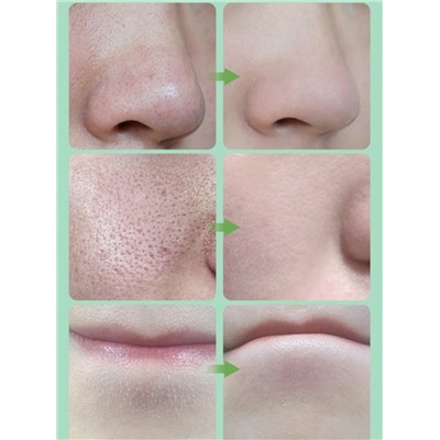 Набор сывороток для очищения от черных точек и сужения пор Bisutang Suction Blackhead Remover, 2 шт. * 10 мл.